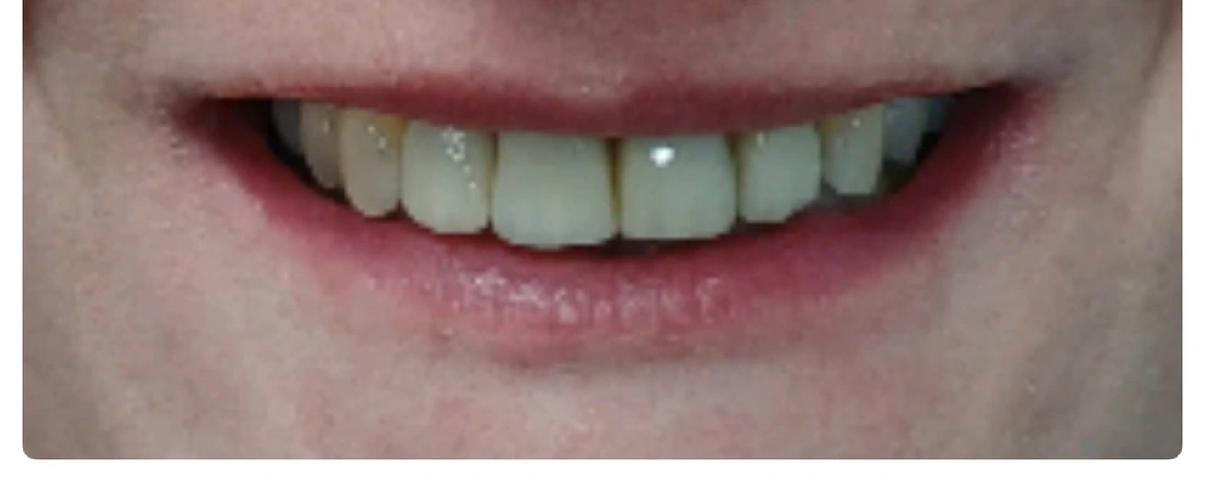 Sonrisa tras carillas de porcelana — Dental Estetic Oeste