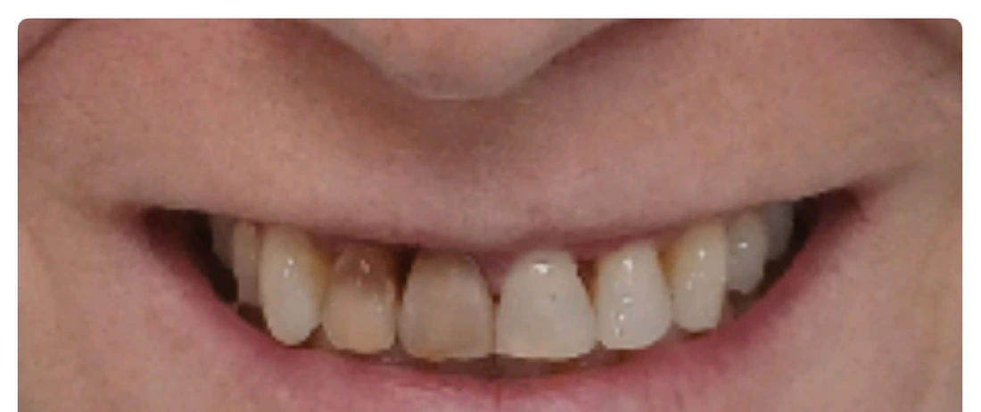 Sonrisa antes del diseño de sonrisa con carillas — Dental Estetic Oeste