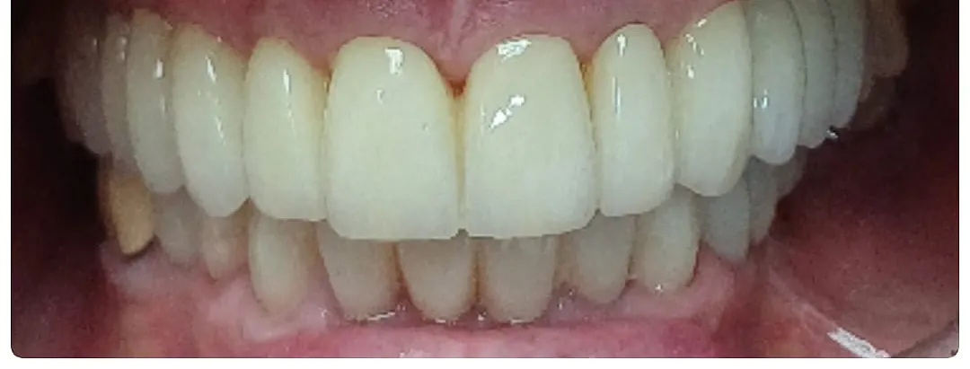 Coronas de porcelana sobre rehabilitación oral — caso real Dental Estetic Oeste Getafe