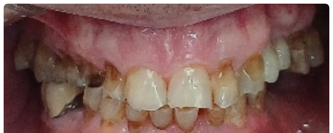 Sonrisa antes de rehabilitación con coronas de porcelana — Dental Estetic Oeste